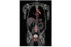 Siemens kupuje CTI Molecular Imaging