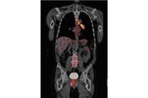 Siemens kupuje CTI Molecular Imaging