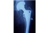 Czujnik skróci czas rehabilitacji po przeszczepach implantów