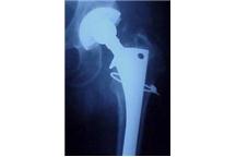 Czujnik skróci czas rehabilitacji po przeszczepach implantów Czujnik skróci czas rehabilitacji po przeszczepach implantów
